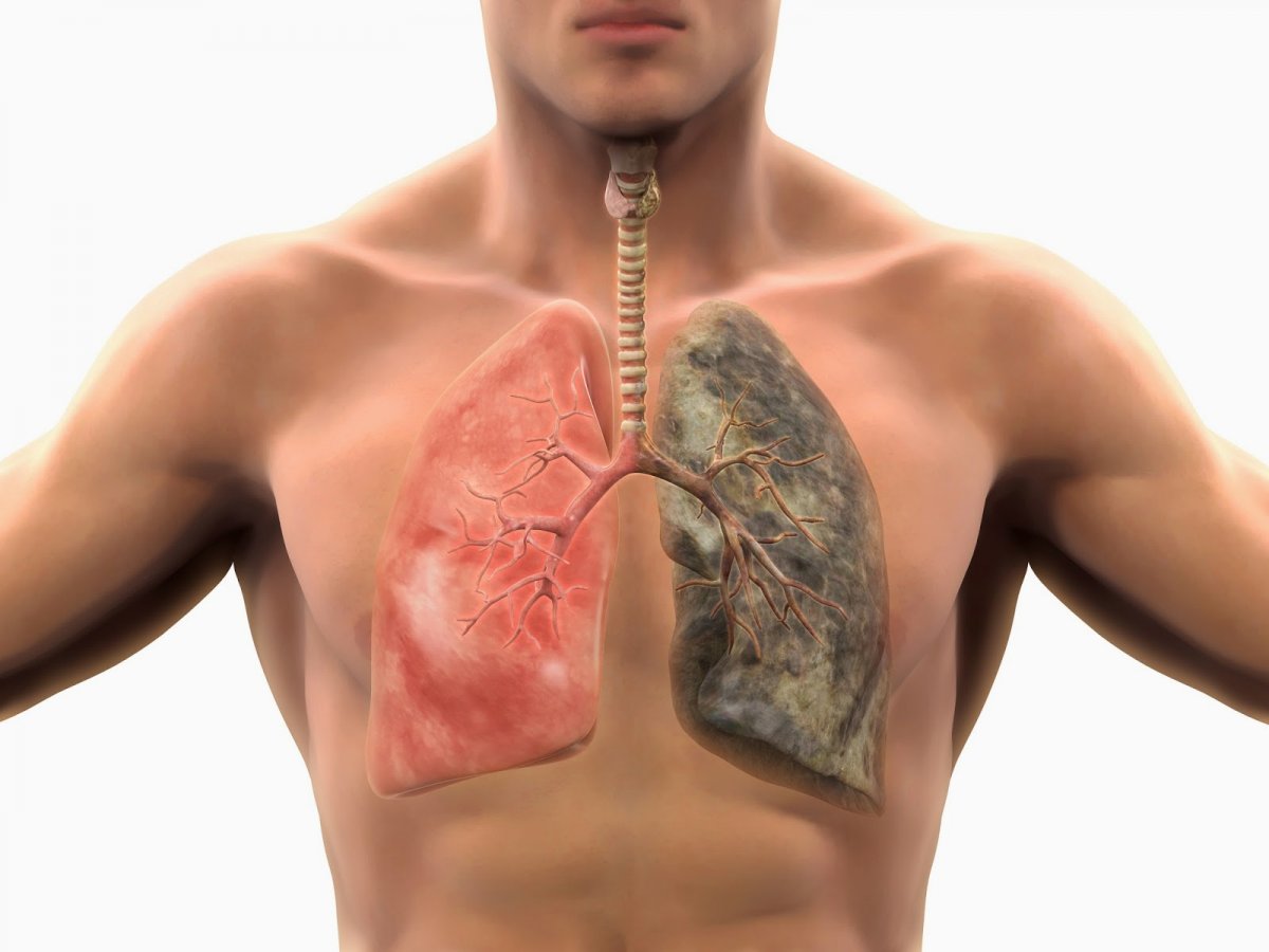 Atenţie fumători! Semnul BANAL care te ajută să depistezi CANCERUL pulmonar în stadiul INCIPIENT